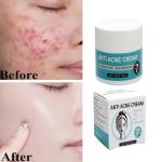 Remove acne, blackheads, shrink pores, and reduce acne marks
