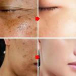 Whitening Freckle Cream – Melasma, Dark Spot & Pigmentation Removal for Brighter, Even Skin.