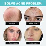 Remove acne, blackheads, shrink pores, and reduce acne marks