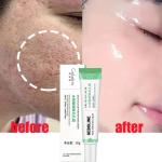 Salicylic Acid Cream - Reduces blackheads, tightens skin, and shrinks pores.