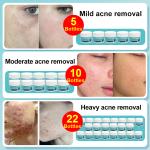 Remove acne, blackheads, shrink pores, and reduce acne marks