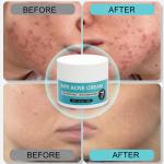 Remove acne, blackheads, shrink pores, and reduce acne marks