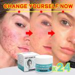 Remove acne, blackheads, shrink pores, and reduce acne marks