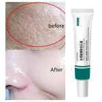 Salicylic Acid Pore Shrinking Cream – Tightens Face, Smooths Skin, and Eliminates Blackheads & Large Pores.