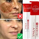 Whitening Freckle Cream – Melasma, Dark Spot & Pigmentation Removal for Brighter, Even Skin.