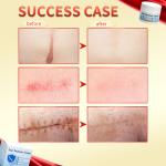 Fast Scar Removal Cream Treatment Stretch Marks Burn Surgical Scar Gel Acne Scar Spot Marks Repair Firming Smooth Body Skin Care
