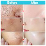Salicylic Acid Pore Shrinking Cream – Tightens Face, Smooths Skin, and Eliminates Blackheads & Large Pores.