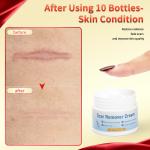 Fast Scar Removal Cream Treatment Stretch Marks Burn Surgical Scar Gel Acne Scar Spot Marks Repair Firming Smooth Body Skin Care